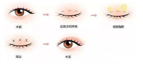 三点定位双眼皮手术方式 三点定位双眼皮手术方式