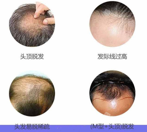 不同脱发类型展示