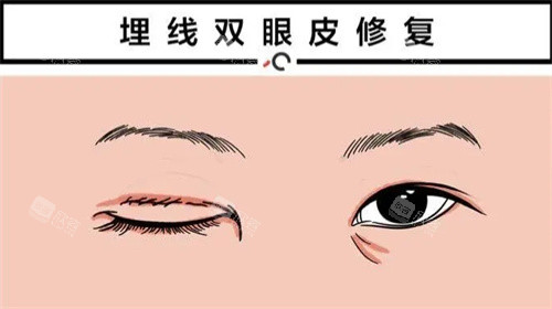 双眼皮修复动画图 双眼皮修复动画图