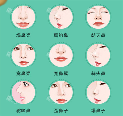 鼻部整形适应症 鼻部整形适应症