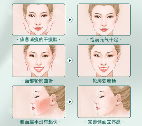脂肪填充适应症 脂肪填充适应症