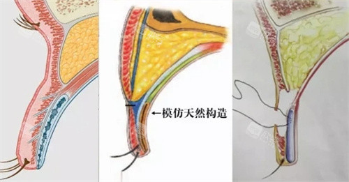 双眼皮缝合结构图 双眼皮缝合结构图