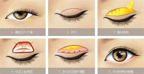 双眼皮手术流程图 双眼皮手术流程图