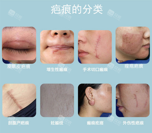 芜湖去疤痕的医院哪家好?揭晓芜湖哪个医院修复疤痕好!