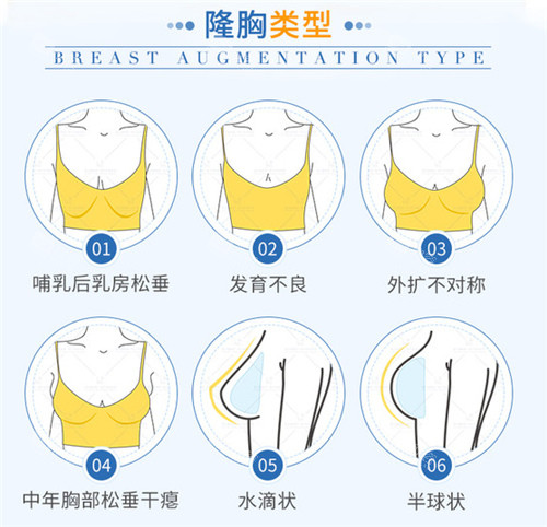 芜湖隆胸手术医院排名揭秘自体脂肪/假体丰胸哪家医院好!