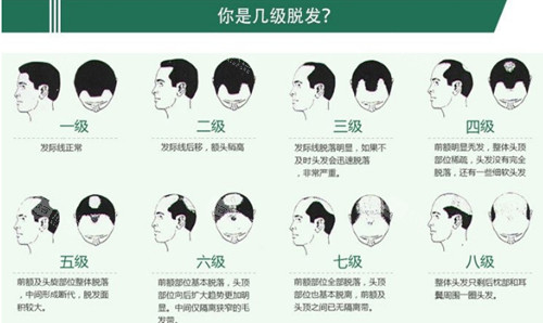 脱发等级展示图 脱发等级展示图