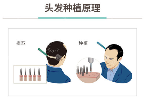 植发手术原理 植发手术原理