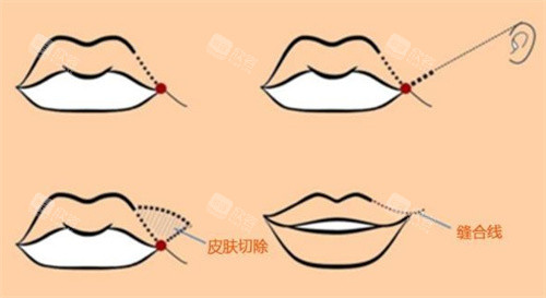 厚唇改薄过程图