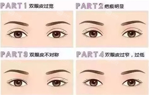 双眼皮失败四种图片 双眼皮失败四种图片
