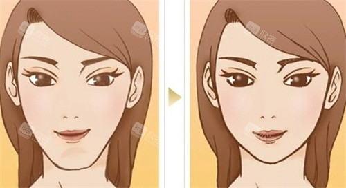 下巴整形对比图