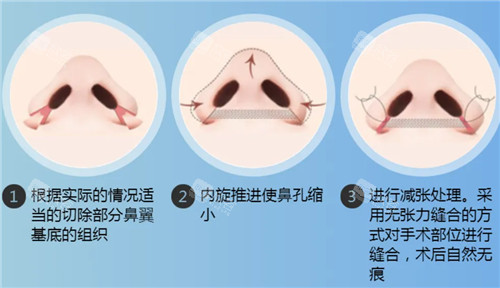 鼻翼缩小手术图示 鼻翼缩小手术图示