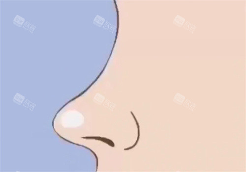 鼻部整形动画图 鼻部整形动画图