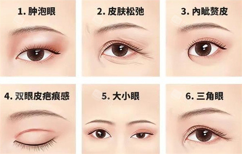 六种不同双眼皮形态 六种不同双眼皮形态