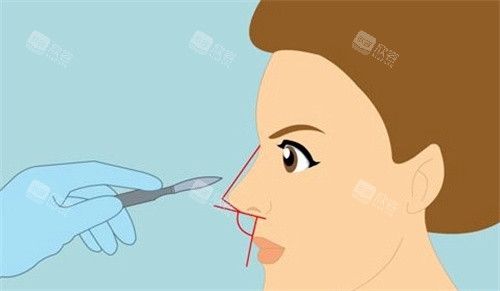 鼻部整形动画图