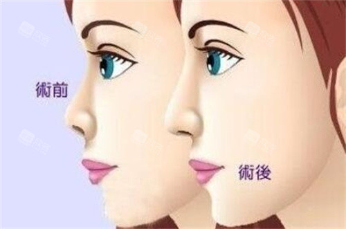 隆鼻前后动画对比图