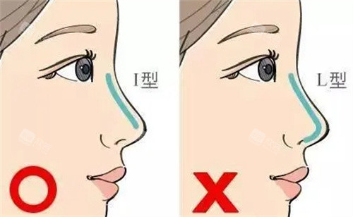L型与I型假体参考图