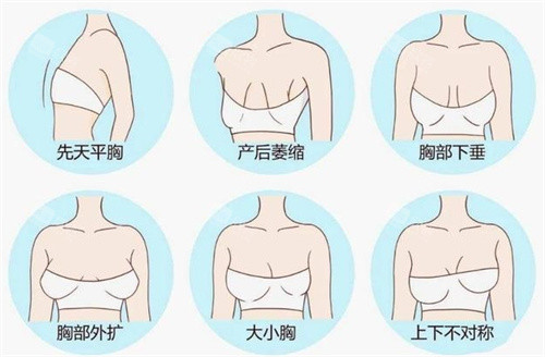 六种不同形态的胸部 六种不同形态的胸部