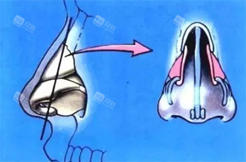 隆鼻结构图 隆鼻结构图