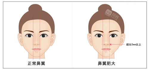 鼻翼缩小动画图示 鼻翼缩小动画图示