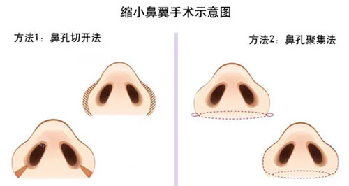 鼻翼缩小手术过程 鼻翼缩小手术过程