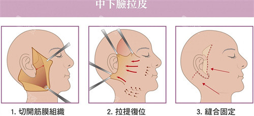 中下面部提升动画图 中下面部提升动画图
