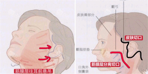 拉皮切口演示图 拉皮切口演示图