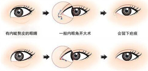 开眼角动画图 开眼角动画图