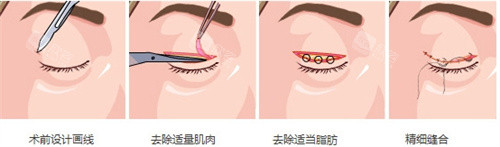 双眼皮手术流程图 双眼皮手术流程图