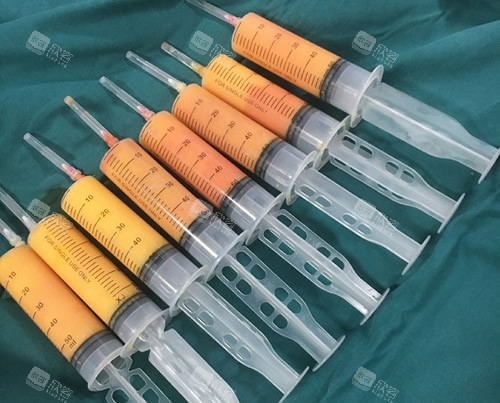 吸脂手术的脂肪 吸脂手术的脂肪
