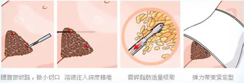 吸脂动画图 吸脂动画图