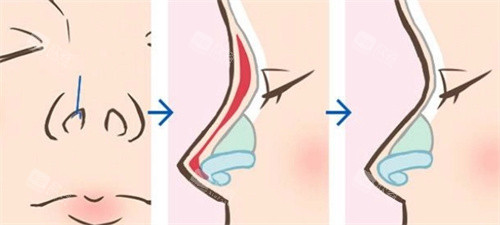 隆鼻动画图 隆鼻动画图