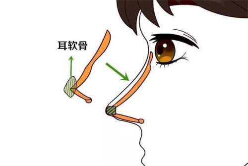 耳软骨隆鼻动画图