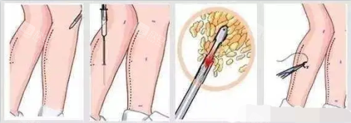 腿部吸脂示意图