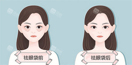 去眼袋前后图示 去眼袋前后图示