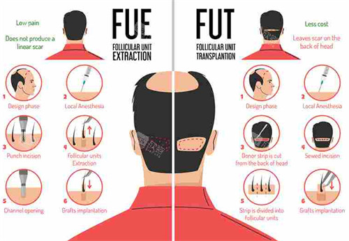 FUE和FUT对比图 FUE和FUT对比图