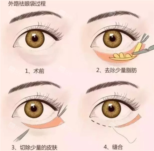 下眼睑手术步骤图