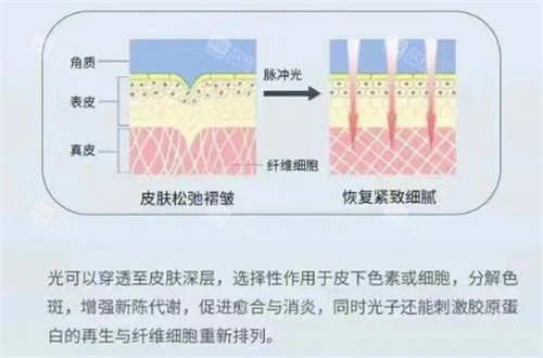 光子嫩肤原理图片 光子嫩肤原理图片