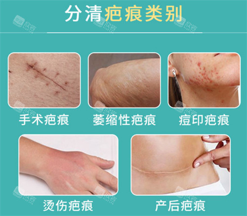 疤痕的类别 疤痕的类别