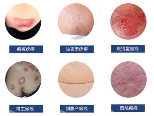 不同类型的疤痕 不同类型的疤痕
