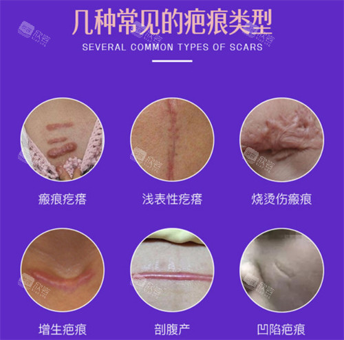 几种常见的疤痕类型 几种常见的疤痕类型