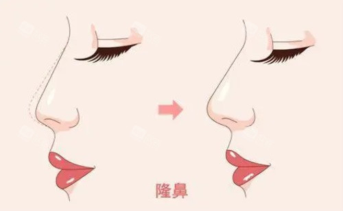 隆鼻对比图 隆鼻对比图