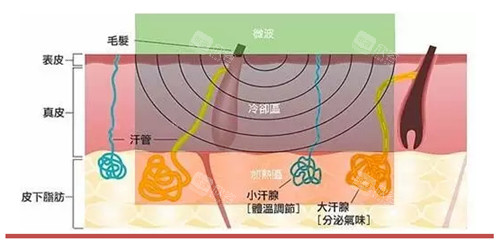 除腋臭原理图