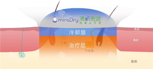 去腋臭图示