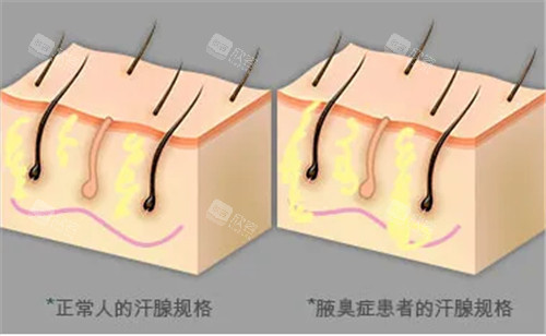 汗腺对比图示