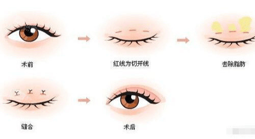 三点式双眼皮