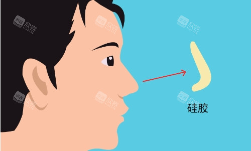硅胶隆鼻示意图 硅胶隆鼻示意图