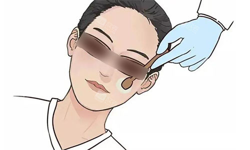 光子嫩肤示意图 光子嫩肤示意图