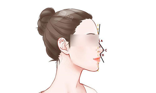 隆鼻手术示意图