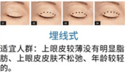 双眼皮还不会选择？这篇文章告诉你，你适合什么样的双眼皮