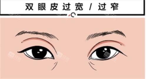 双眼皮过宽过窄动画显示图